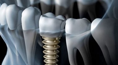 marmara_dis_klinigi_dental_implants-673x304-380x210